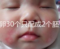取卵30個只配成2個胚胎別放棄！卵巢傷口小移植成功率不低