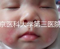 北京醫(yī)科大學(xué)第三醫(yī)院nt檢查費(fèi)用盤(pán)點(diǎn)需要多長(zhǎng)時(shí)間,是否預(yù)約