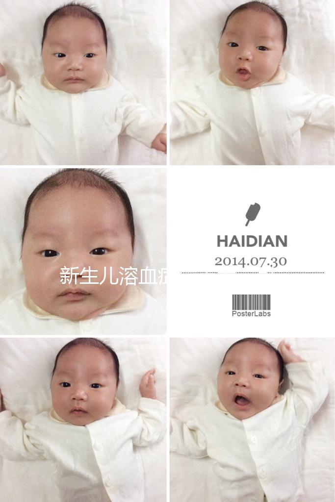 新生兒溶血癥危害大，引發膽紅素腦病可致神經后遺癥