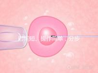 時間短、操作簡單,分步驟解讀宮頸擴(kuò)張術(shù)全過程