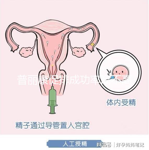 普麗康促排成功率高不高揭秘，能否取出卵泡的關鍵看…