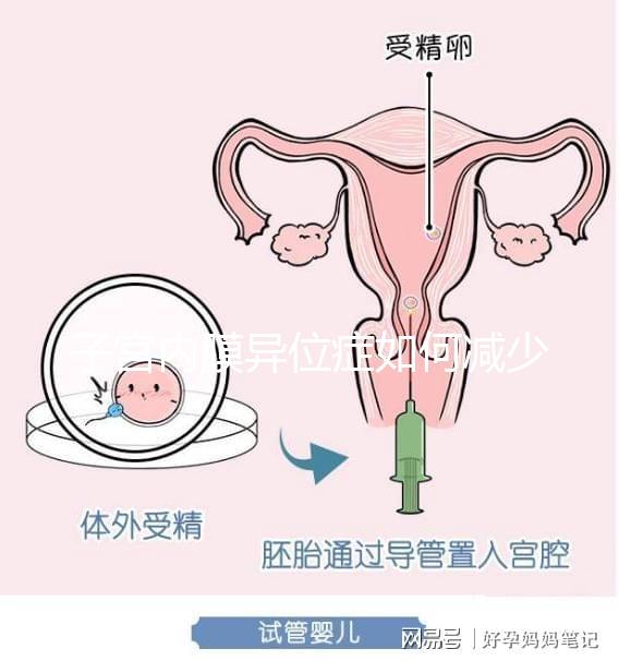 子宮內膜異位癥如何減少手術次數，增加試管嬰兒成功率？