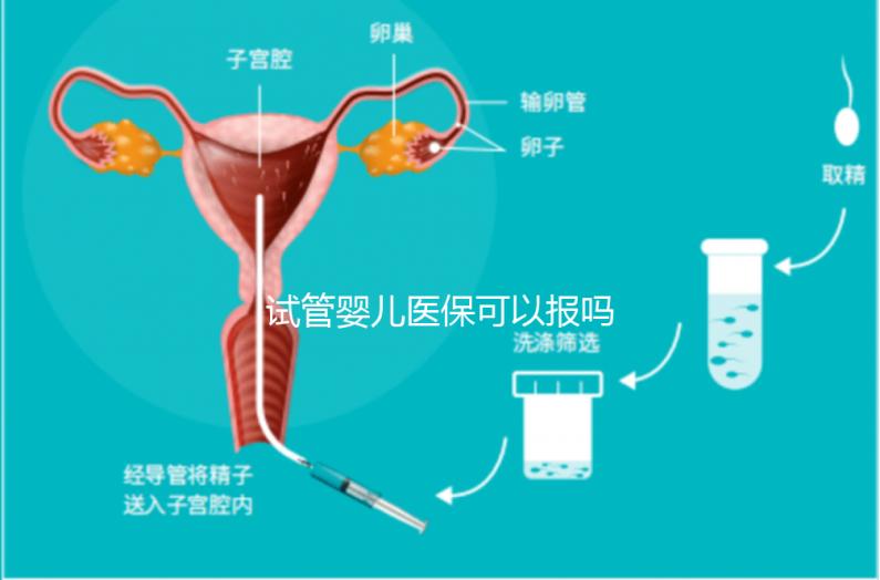 試管嬰兒醫保可以報嗎