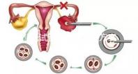 誰說試管空卵泡只是方案不對,怎么回事看完一清二楚?
